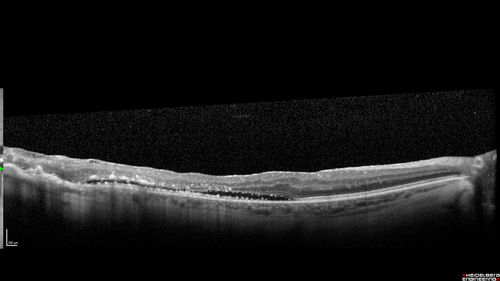 Hyperpigmented Vasoproliferative Tumor on Buckle with New Serous Retinal Detachment 20 years post RD Repair
67 year old female RD repair OU 1999 then severe (20/400) macular pucker OD removed 3 months later (twin sister also had bilateral RDâ€™s with PVR).  Then dislocated IOL surgery right eye 9/2012.  New vision loss in the right eye with serous retinal detachment.  Argon laser to dark tumor led to resolution of subretinal fluid within a month.
