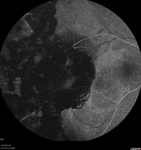 Hyperpigmented Vasoproliferative Tumor on Buckle with New Serous Retinal Detachment 20 years post RD Repair
67 year old female RD repair OU 1999 then severe (20/400) macular pucker OD removed 3 months later (twin sister also had bilateral RDâ€™s with PVR).  Then dislocated IOL surgery right eye 9/2012.  New vision loss in the right eye with serous retinal detachment.  Argon laser to dark tumor led to resolution of subretinal fluid within a month.

