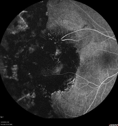 Hyperpigmented Vasoproliferative Tumor on Buckle with New Serous Retinal Detachment 20 years post RD Repair
67 year old female RD repair OU 1999 then severe (20/400) macular pucker OD removed 3 months later (twin sister also had bilateral RDâ€™s with PVR).  Then dislocated IOL surgery right eye 9/2012.  New vision loss in the right eye with serous retinal detachment.  Argon laser to dark tumor led to resolution of subretinal fluid within a month.
