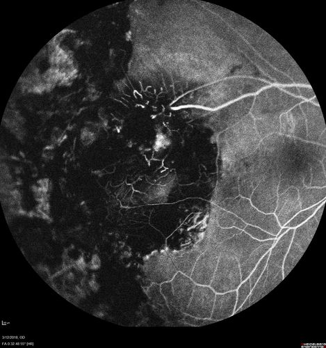 Hyperpigmented Vasoproliferative Tumor on Buckle with New Serous Retinal Detachment 20 years post RD Repair
67 year old female RD repair OU 1999 then severe (20/400) macular pucker OD removed 3 months later (twin sister also had bilateral RDâ€™s with PVR).  Then dislocated IOL surgery right eye 9/2012.  New vision loss in the right eye with serous retinal detachment.  Argon laser to dark tumor led to resolution of subretinal fluid within a month.
