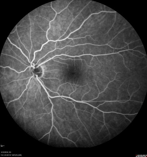 Hyperpigmented Vasoproliferative Tumor on Buckle with New Serous Retinal Detachment 20 years post RD Repair
67 year old female RD repair OU 1999 then severe (20/400) macular pucker OD removed 3 months later (twin sister also had bilateral RDâ€™s with PVR).  Then dislocated IOL surgery right eye 9/2012.  New vision loss in the right eye with serous retinal detachment.  Argon laser to dark tumor led to resolution of subretinal fluid within a month.
