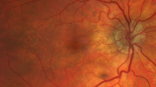Asymptomatic exudative wet age-related macular degeneration
78 year old man with scar in the left eye being treated regularly and returns with new lesions in the right eye which is not symptomatic.  Vision is 20/25 right eye and 20/125 left eye.  The lesion was treated and responded to anti-VEGF therapy
