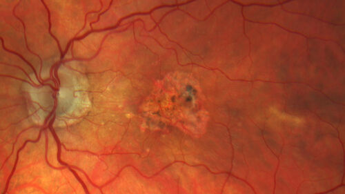 Asymptomatic exudative wet age-related macular degeneration
78 year old man with scar in the left eye being treated regularly and returns with new lesions in the right eye which is not symptomatic.  Vision is 20/25 right eye and 20/125 left eye.  The lesion was treated and responded to anti-VEGF therapy
