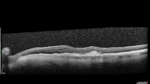 Asymptomatic exudative wet age-related macular degeneration
78 year old man with scar in the left eye being treated regularly and returns with new lesions in the right eye which is not symptomatic.  Vision is 20/25 right eye and 20/125 left eye.  The lesion was treated and responded to anti-VEGF therapy
