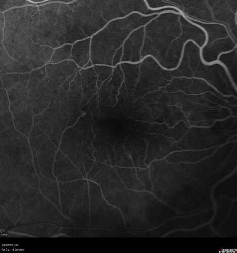 Asymptomatic exudative wet age-related macular degeneration
78 year old man with scar in the left eye being treated regularly and returns with new lesions in the right eye which is not symptomatic.  Vision is 20/25 right eye and 20/125 left eye.  The lesion was treated and responded to anti-VEGF therapy
