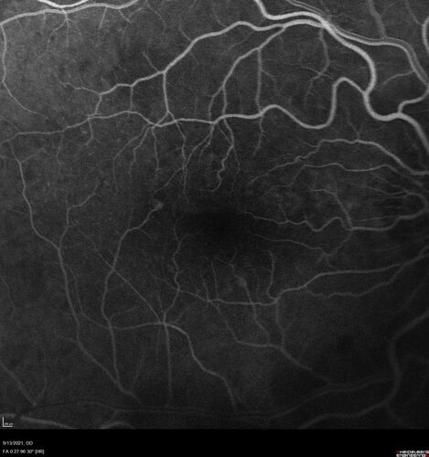 Asymptomatic exudative wet age-related macular degeneration
78 year old man with scar in the left eye being treated regularly and returns with new lesions in the right eye which is not symptomatic.  Vision is 20/25 right eye and 20/125 left eye.  The lesion was treated and responded to anti-VEGF therapy
