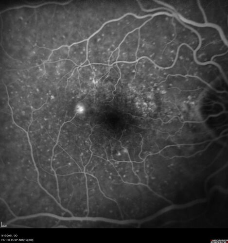 Asymptomatic exudative wet age-related macular degeneration
78 year old man with scar in the left eye being treated regularly and returns with new lesions in the right eye which is not symptomatic.  Vision is 20/25 right eye and 20/125 left eye.  The lesion was treated and responded to anti-VEGF therapy
