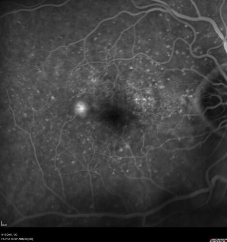 Asymptomatic exudative wet age-related macular degeneration
78 year old man with scar in the left eye being treated regularly and returns with new lesions in the right eye which is not symptomatic.  Vision is 20/25 right eye and 20/125 left eye.  The lesion was treated and responded to anti-VEGF therapy
