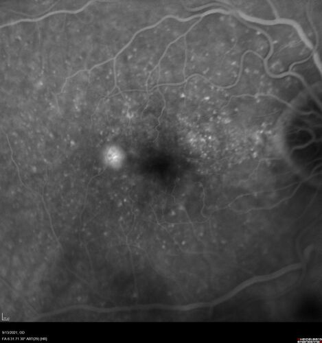 Asymptomatic exudative wet age-related macular degeneration
78 year old man with scar in the left eye being treated regularly and returns with new lesions in the right eye which is not symptomatic.  Vision is 20/25 right eye and 20/125 left eye.  The lesion was treated and responded to anti-VEGF therapy
