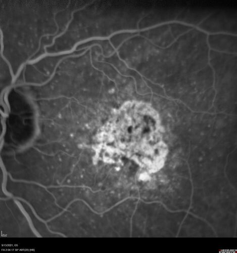 Asymptomatic exudative wet age-related macular degeneration
78 year old man with scar in the left eye being treated regularly and returns with new lesions in the right eye which is not symptomatic.  Vision is 20/25 right eye and 20/125 left eye.  The lesion was treated and responded to anti-VEGF therapy
