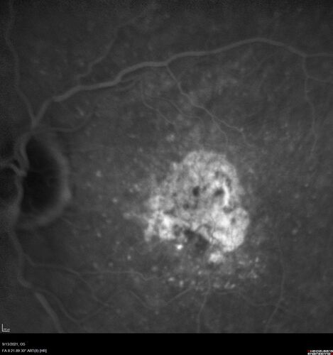 Asymptomatic exudative wet age-related macular degeneration
78 year old man with scar in the left eye being treated regularly and returns with new lesions in the right eye which is not symptomatic.  Vision is 20/25 right eye and 20/125 left eye.  The lesion was treated and responded to anti-VEGF therapy
