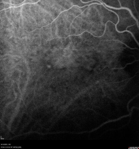 Asymptomatic exudative wet age-related macular degeneration
78 year old man with scar in the left eye being treated regularly and returns with new lesions in the right eye which is not symptomatic.  Vision is 20/25 right eye and 20/125 left eye.  The lesion was treated and responded to anti-VEGF therapy
