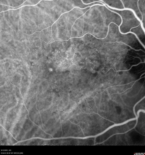 Asymptomatic exudative wet age-related macular degeneration
78 year old man with scar in the left eye being treated regularly and returns with new lesions in the right eye which is not symptomatic.  Vision is 20/25 right eye and 20/125 left eye.  The lesion was treated and responded to anti-VEGF therapy
