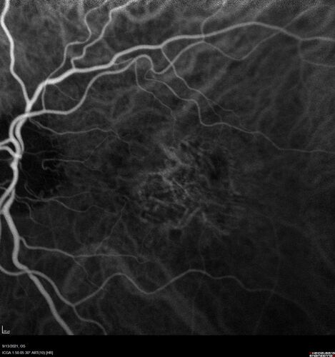 Asymptomatic exudative wet age-related macular degeneration
78 year old man with scar in the left eye being treated regularly and returns with new lesions in the right eye which is not symptomatic.  Vision is 20/25 right eye and 20/125 left eye.  The lesion was treated and responded to anti-VEGF therapy
