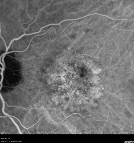 Asymptomatic exudative wet age-related macular degeneration
78 year old man with scar in the left eye being treated regularly and returns with new lesions in the right eye which is not symptomatic.  Vision is 20/25 right eye and 20/125 left eye.  The lesion was treated and responded to anti-VEGF therapy
