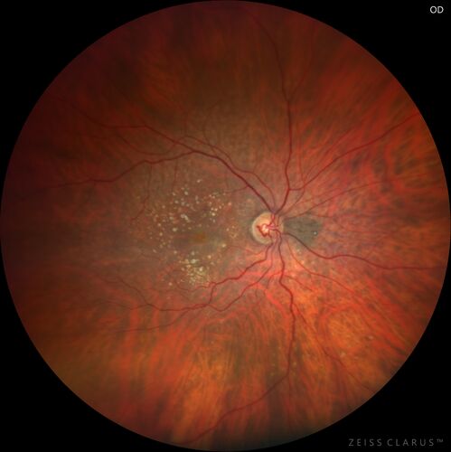 Wet age-related macular degeneration - Classic Juxtafoveal Choroidal Neovascular Membrane
80 year old female with mild vision loss.  20/40 OD, 20/25 OS.  Avastin controlled disease.  VA improved to 20/25 after 2 injections.  At 1 year she is getting every 2 months treatment
