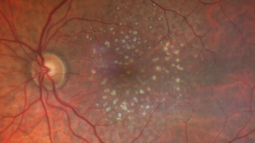 Wet age-related macular degeneration - Classic Juxtafoveal Choroidal Neovascular Membrane
80 year old female with mild vision loss.  20/40 OD, 20/25 OS.  Avastin controlled disease.  VA improved to 20/25 after 2 injections.  At 1 year she is getting every 2 months treatment
