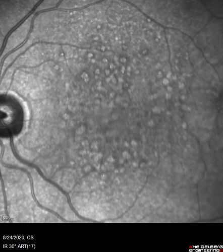 Wet age-related macular degeneration - Classic Juxtafoveal Choroidal Neovascular Membrane
80 year old female with mild vision loss.  20/40 OD, 20/25 OS.  Avastin controlled disease.  VA improved to 20/25 after 2 injections.  At 1 year she is getting every 2 months treatment
