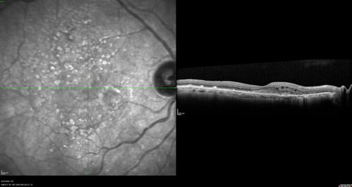 Wet age-related macular degeneration - Classic Juxtafoveal Choroidal Neovascular Membrane
80 year old female with mild vision loss.  20/40 OD, 20/25 OS.  Avastin controlled disease.  VA improved to 20/25 after 2 injections.  At 1 year she is getting every 2 months treatment
