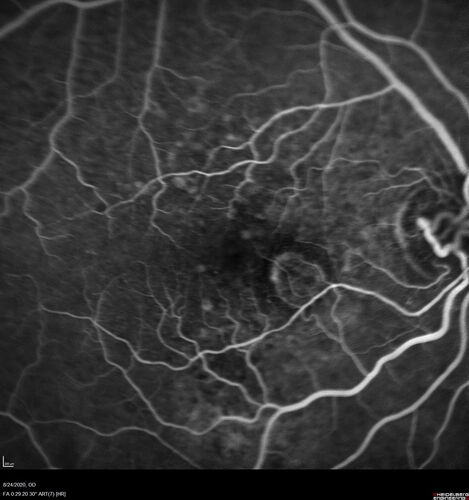 Wet age-related macular degeneration - Classic Juxtafoveal Choroidal Neovascular Membrane
80 year old female with mild vision loss.  20/40 OD, 20/25 OS.  Avastin controlled disease.  VA improved to 20/25 after 2 injections.  At 1 year she is getting every 2 months treatment
