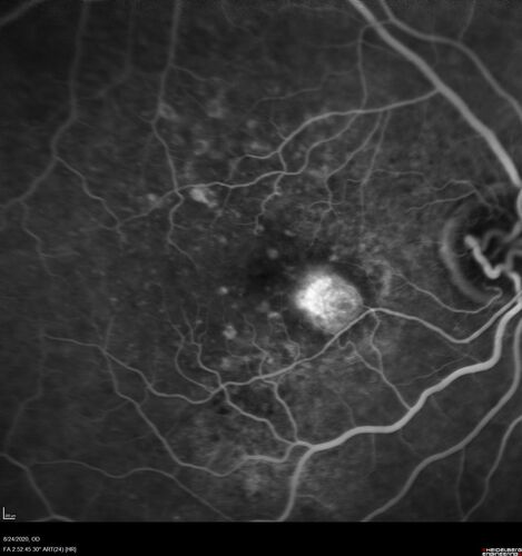 Wet age-related macular degeneration - Classic Juxtafoveal Choroidal Neovascular Membrane
80 year old female with mild vision loss.  20/40 OD, 20/25 OS.  Avastin controlled disease.  VA improved to 20/25 after 2 injections.  At 1 year she is getting every 2 months treatment
