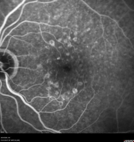 Wet age-related macular degeneration - Classic Juxtafoveal Choroidal Neovascular Membrane
80 year old female with mild vision loss.  20/40 OD, 20/25 OS.  Avastin controlled disease.  VA improved to 20/25 after 2 injections.  At 1 year she is getting every 2 months treatment
