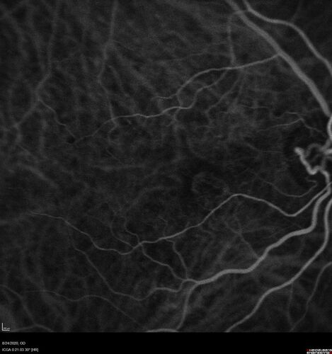 Wet age-related macular degeneration - Classic Juxtafoveal Choroidal Neovascular Membrane
80 year old female with mild vision loss.  20/40 OD, 20/25 OS.  Avastin controlled disease.  VA improved to 20/25 after 2 injections.  At 1 year she is getting every 2 months treatment
