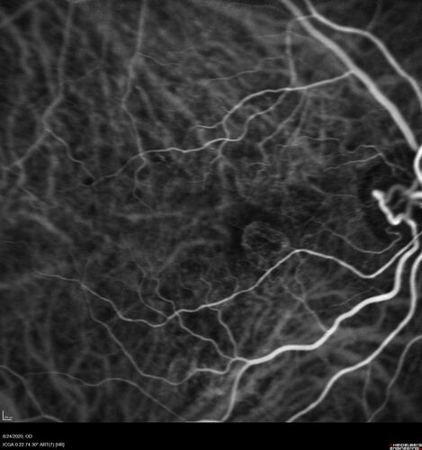 Wet age-related macular degeneration - Classic Juxtafoveal Choroidal Neovascular Membrane
80 year old female with mild vision loss.  20/40 OD, 20/25 OS.  Avastin controlled disease.  VA improved to 20/25 after 2 injections.  At 1 year she is getting every 2 months treatment
