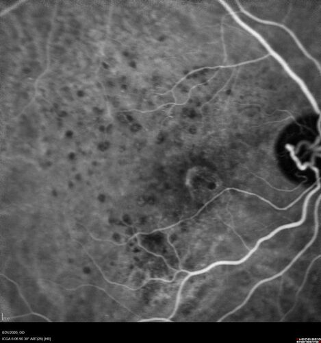 Wet age-related macular degeneration - Classic Juxtafoveal Choroidal Neovascular Membrane
80 year old female with mild vision loss.  20/40 OD, 20/25 OS.  Avastin controlled disease.  VA improved to 20/25 after 2 injections.  At 1 year she is getting every 2 months treatment
