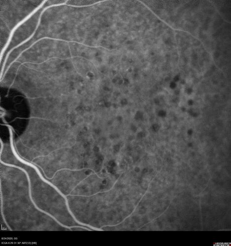 Wet age-related macular degeneration - Classic Juxtafoveal Choroidal Neovascular Membrane
80 year old female with mild vision loss.  20/40 OD, 20/25 OS.  Avastin controlled disease.  VA improved to 20/25 after 2 injections.  At 1 year she is getting every 2 months treatment
