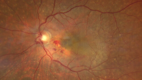 Post Anti-VEGF RPE Tear (Vabysmo)
87 year  old female with vision loss OS (20/125) given 1/4 dose vabysmo and developed RPE tear VA dropped to 20/400
