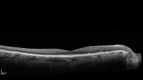 Post Anti-VEGF RPE Tear (Vabysmo)
87 year  old female with vision loss OS (20/125) given 1/4 dose vabysmo and developed RPE tear VA dropped to 20/400
