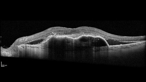 Post Anti-VEGF RPE Tear (Vabysmo)
87 year  old female with vision loss OS (20/125) given 1/4 dose vabysmo and developed RPE tear VA dropped to 20/400
