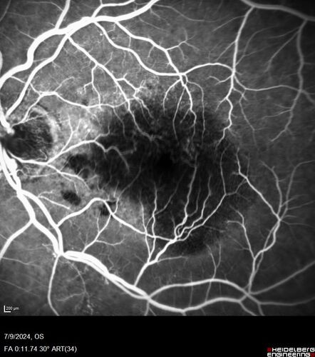 Post Anti-VEGF RPE Tear (Vabysmo)
87 year  old female with vision loss OS (20/125) given 1/4 dose vabysmo and developed RPE tear VA dropped to 20/400
