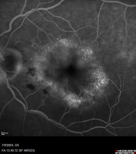 Post Anti-VEGF RPE Tear (Vabysmo)
87 year  old female with vision loss OS (20/125) given 1/4 dose vabysmo and developed RPE tear VA dropped to 20/400
