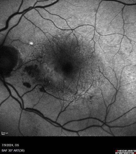Post Anti-VEGF RPE Tear (Vabysmo)
87 year  old female with vision loss OS (20/125) given 1/4 dose vabysmo and developed RPE tear VA dropped to 20/400
