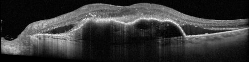 Post Anti-VEGF RPE Tear (Vabysmo)
87 year  old female with vision loss OS (20/125) given 1/4 dose vabysmo and developed RPE tear VA dropped to 20/400
