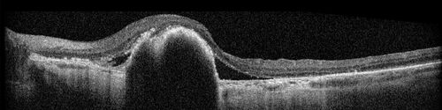 Post Anti-VEGF RPE Tear (Vabysmo)
87 year  old female with vision loss OS (20/125) given 1/4 dose vabysmo and developed RPE tear VA dropped to 20/400
