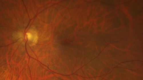 wet AMD - extrafoveal classic choroidal neovascular membrane
72 year old man with good vision in both eyes.  Extrafoveal classic cnvm was picked up and treated with vabysmo
