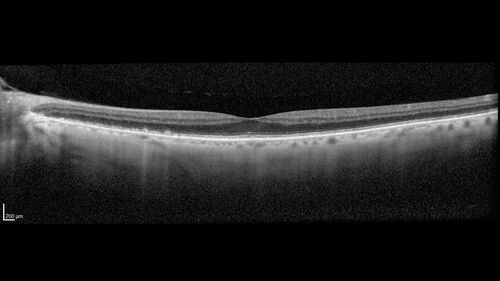 wet AMD - extrafoveal classic choroidal neovascular membrane
72 year old man with good vision in both eyes.  Extrafoveal classic cnvm was picked up and treated with vabysmo
