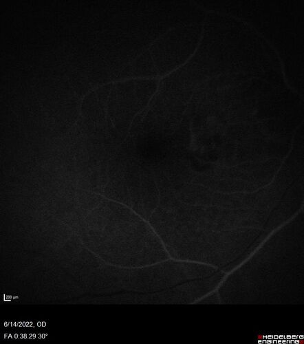 wet AMD - extrafoveal classic choroidal neovascular membrane
72 year old man with good vision in both eyes.  Extrafoveal classic cnvm was picked up and treated with vabysmo
