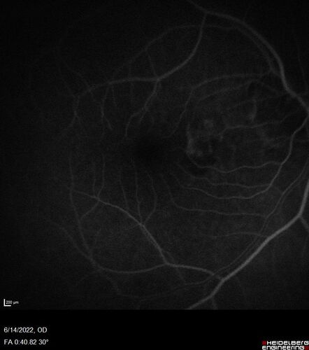wet AMD - extrafoveal classic choroidal neovascular membrane
72 year old man with good vision in both eyes.  Extrafoveal classic cnvm was picked up and treated with vabysmo
