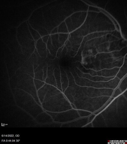 wet AMD - extrafoveal classic choroidal neovascular membrane
72 year old man with good vision in both eyes.  Extrafoveal classic cnvm was picked up and treated with vabysmo
