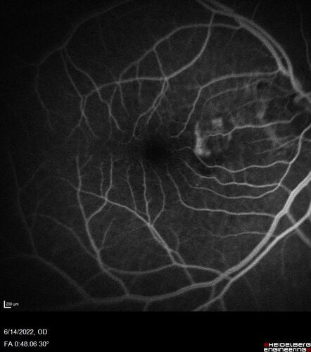 wet AMD - extrafoveal classic choroidal neovascular membrane
72 year old man with good vision in both eyes.  Extrafoveal classic cnvm was picked up and treated with vabysmo
