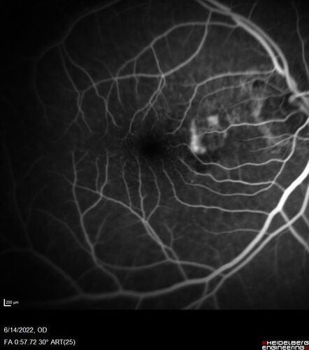 wet AMD - extrafoveal classic choroidal neovascular membrane
72 year old man with good vision in both eyes.  Extrafoveal classic cnvm was picked up and treated with vabysmo
