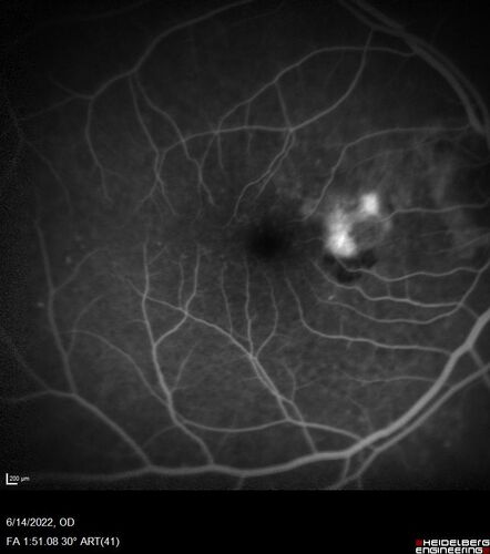 wet AMD - extrafoveal classic choroidal neovascular membrane
72 year old man with good vision in both eyes.  Extrafoveal classic cnvm was picked up and treated with vabysmo
