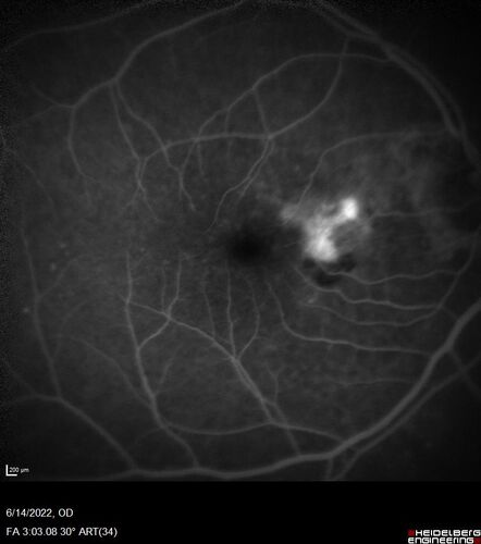 wet AMD - extrafoveal classic choroidal neovascular membrane
72 year old man with good vision in both eyes.  Extrafoveal classic cnvm was picked up and treated with vabysmo
