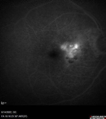 wet AMD - extrafoveal classic choroidal neovascular membrane
72 year old man with good vision in both eyes.  Extrafoveal classic cnvm was picked up and treated with vabysmo
