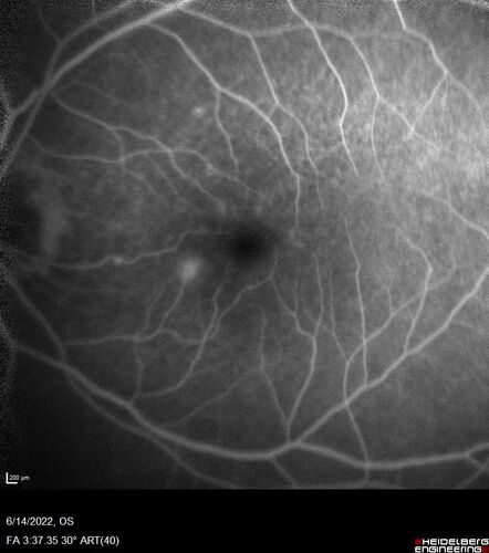 wet AMD - extrafoveal classic choroidal neovascular membrane
72 year old man with good vision in both eyes.  Extrafoveal classic cnvm was picked up and treated with vabysmo
