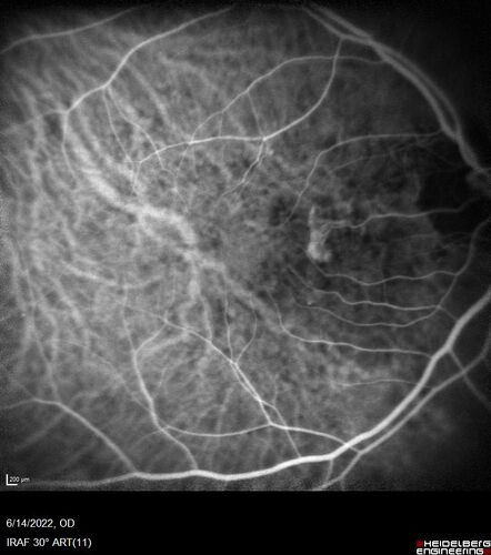 wet AMD - extrafoveal classic choroidal neovascular membrane
72 year old man with good vision in both eyes.  Extrafoveal classic cnvm was picked up and treated with vabysmo
